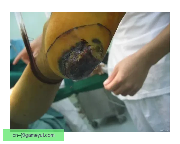 格里利什足部手术自宣赛季报销